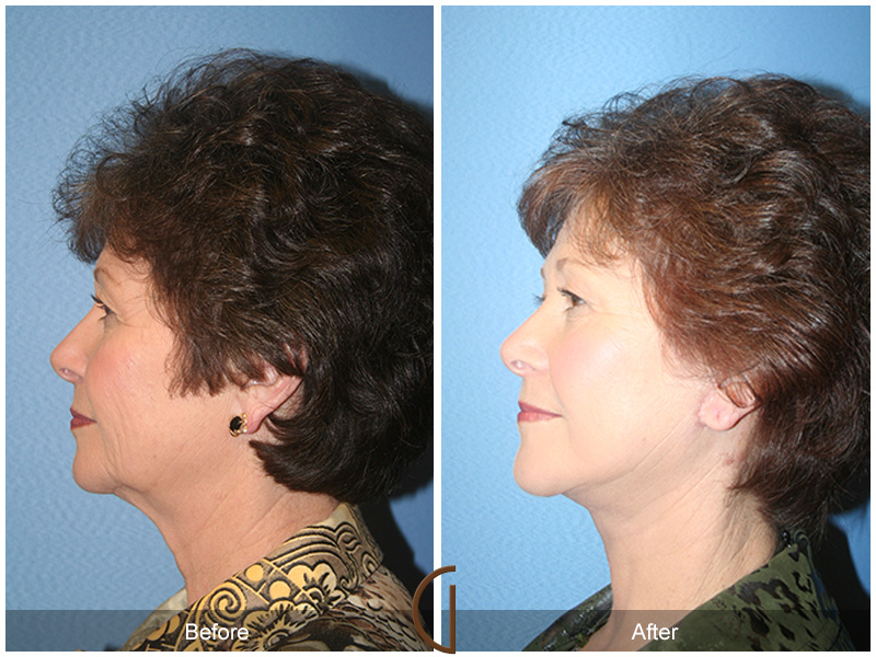 Female Facelift  Before & After Image