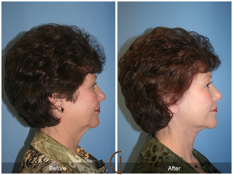 Female Facelift  Before & After Image