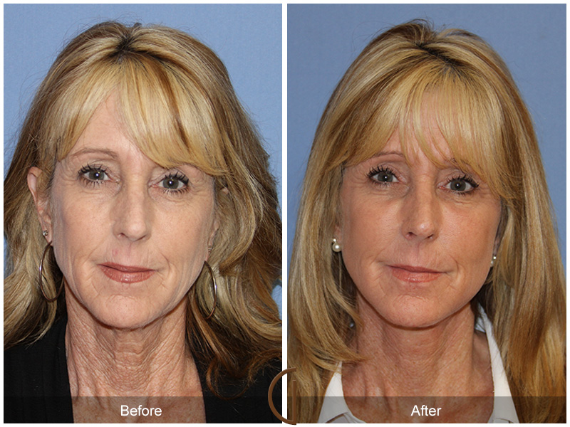 Female Facelift  Before & After Image