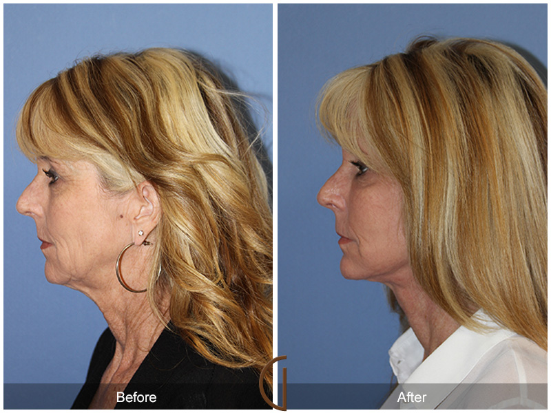 Female Facelift  Before & After Image