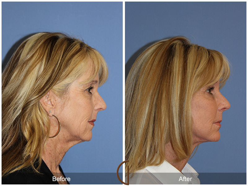 Female Facelift  Before & After Image