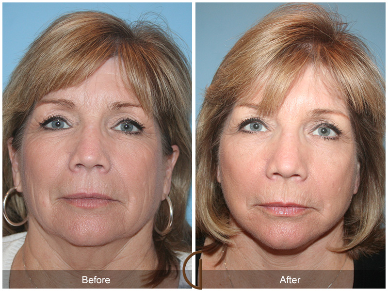 Female Facelift  Before & After Image