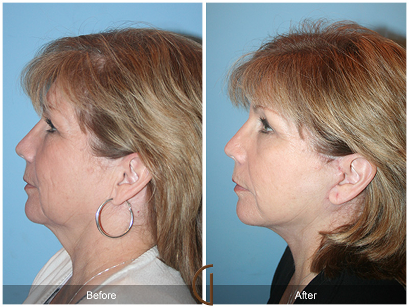 Female Facelift  Before & After Image