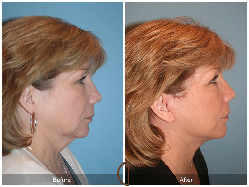 Female Facelift  Before & After Image