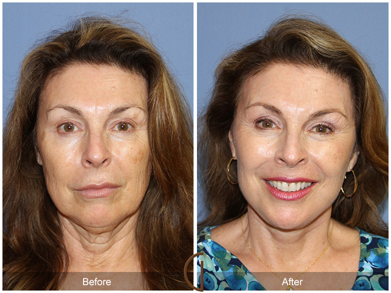 Female Facelift  Before & After Image