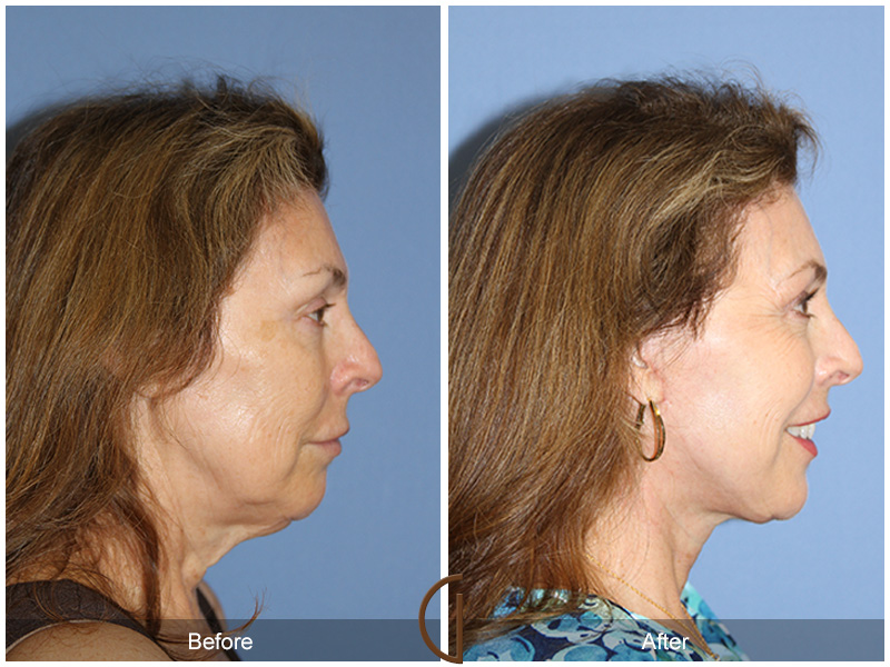 Female Facelift  Before & After Image