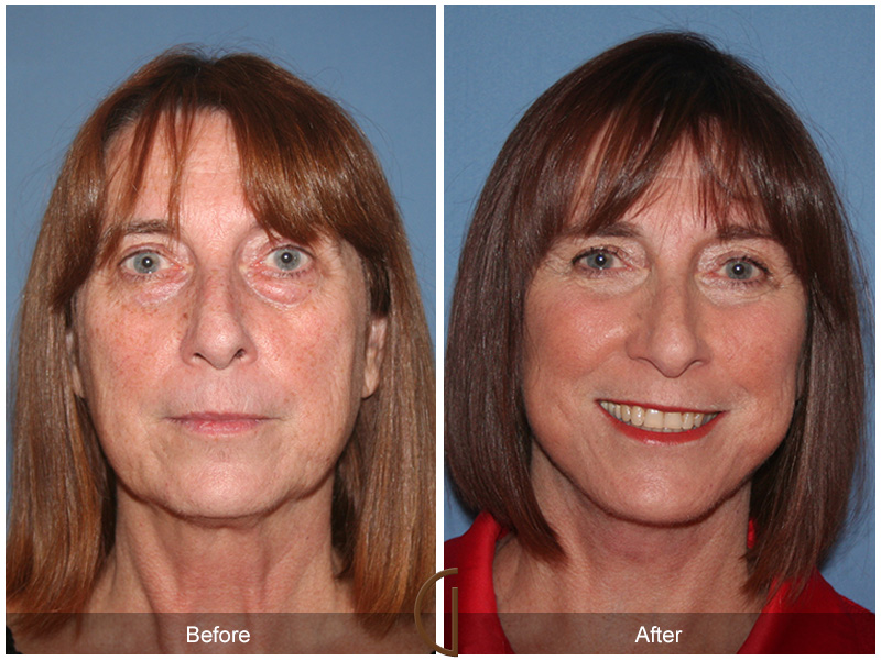 Female Facelift  Before & After Image