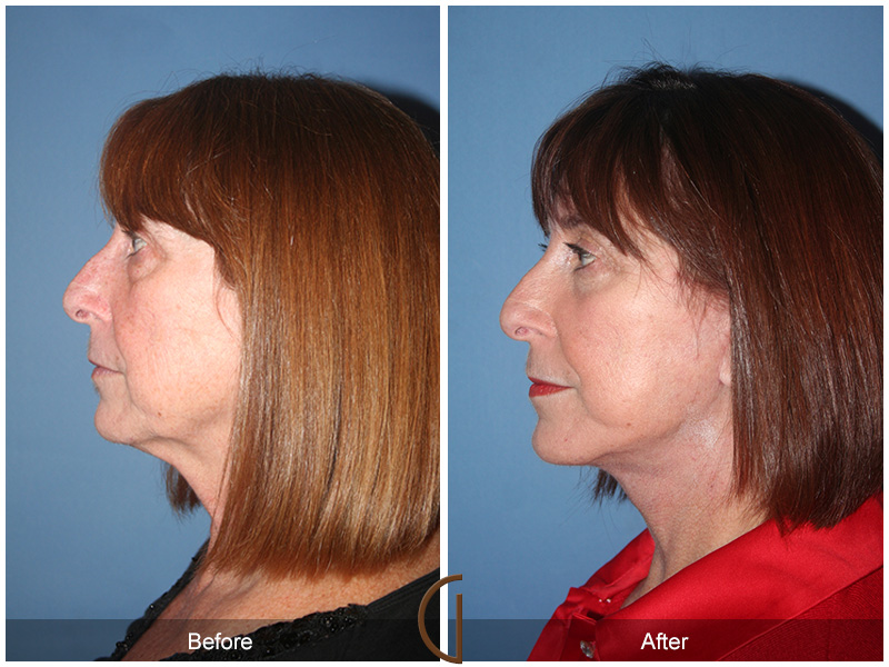 Female Facelift  Before & After Image