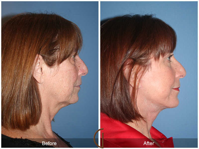 Female Facelift  Before & After Image