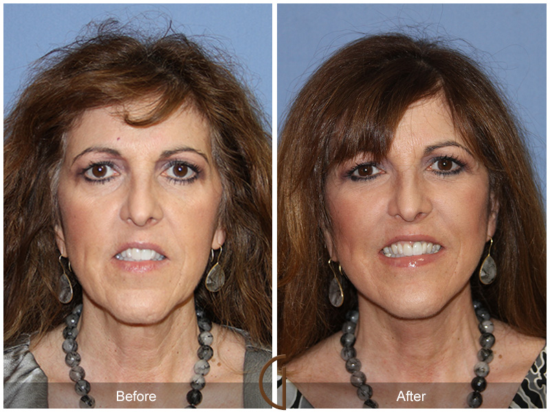 Female Facelift  Before & After Image