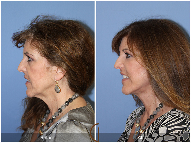 Female Facelift  Before & After Image