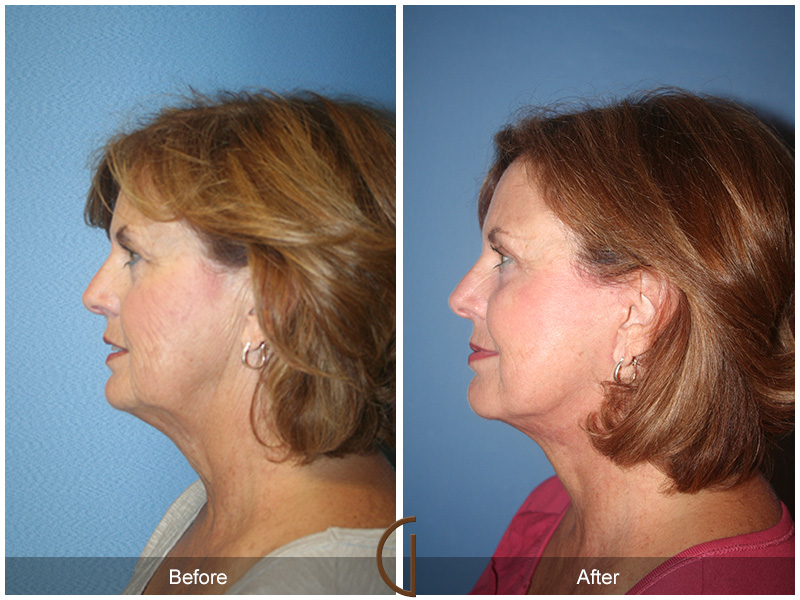 Female Facelift  Before & After Image