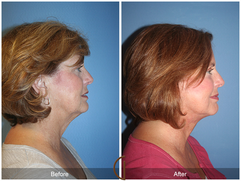 Female Facelift  Before & After Image