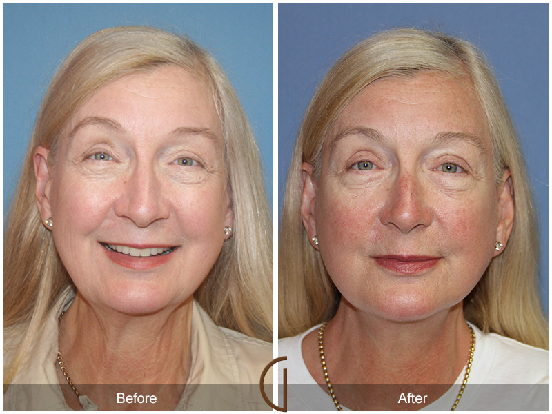 Female Facelift  Before & After Image