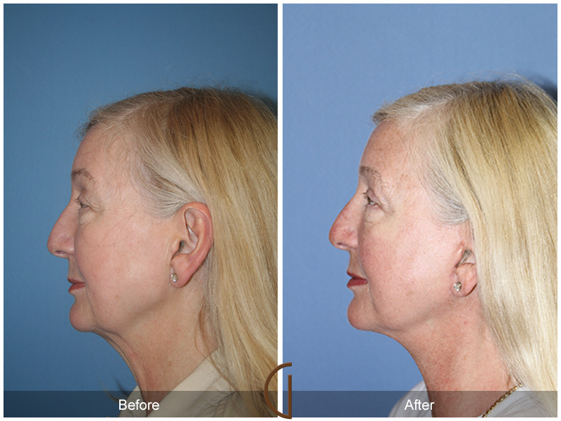 Female Facelift  Before & After Image