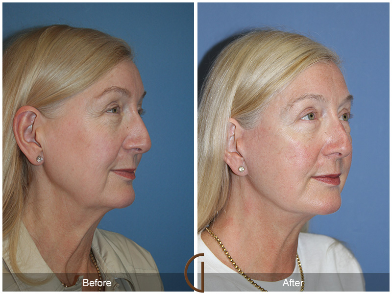 Female Facelift  Before & After Image