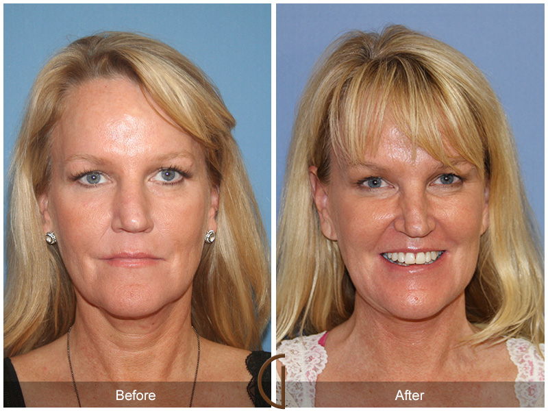 Female Facelift  Before & After Image