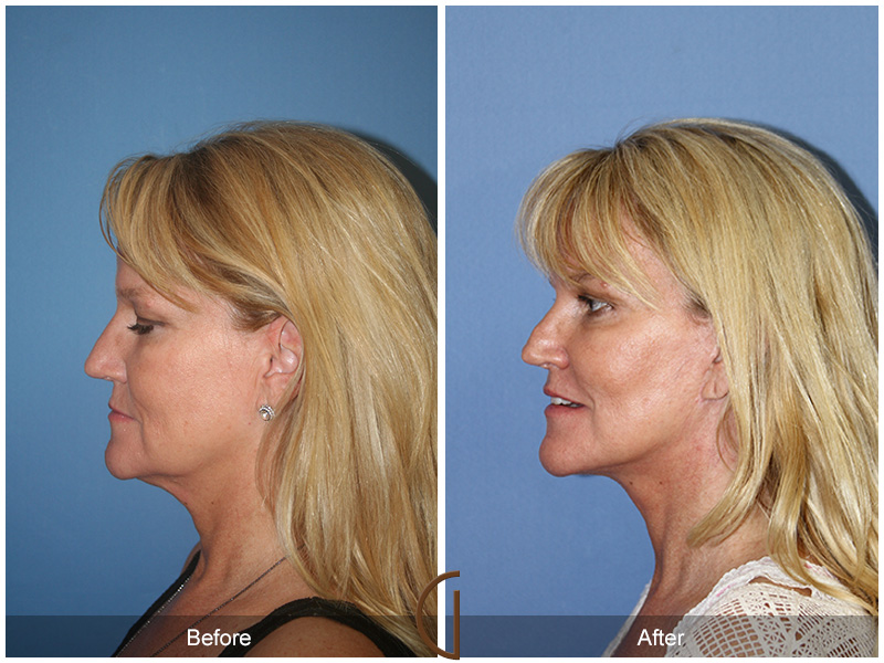 Female Facelift  Before & After Image