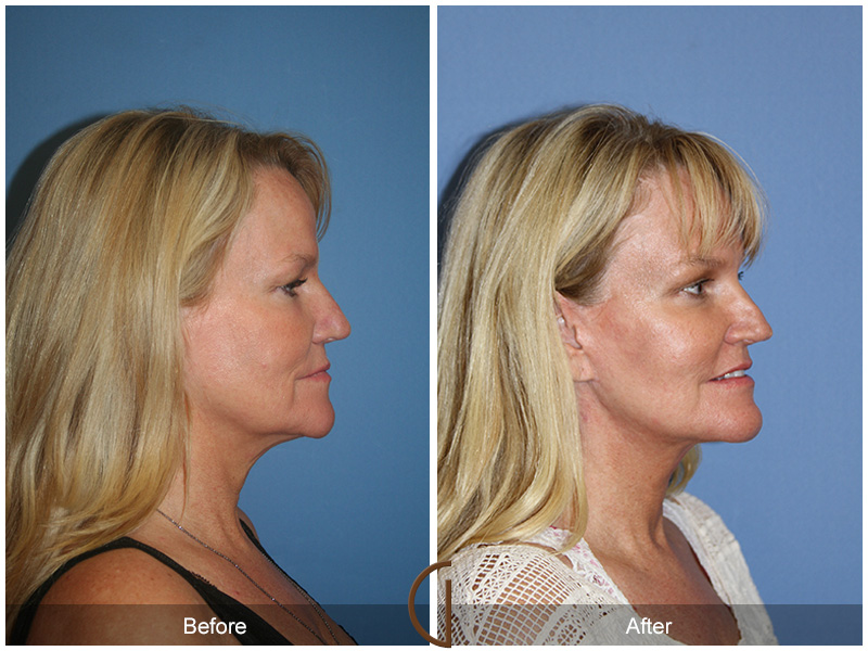 Female Facelift  Before & After Image