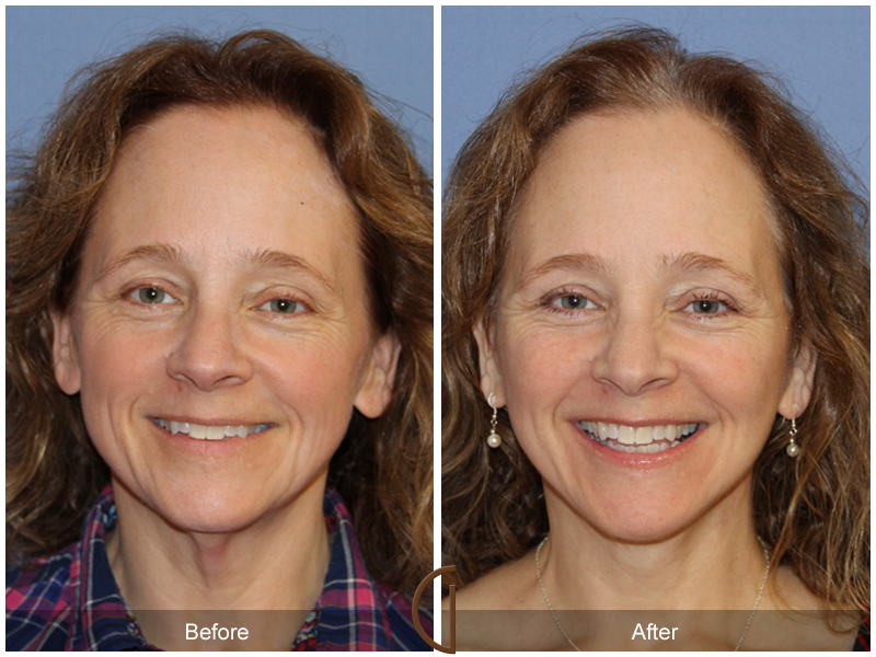 Female Facelift  Before & After Image