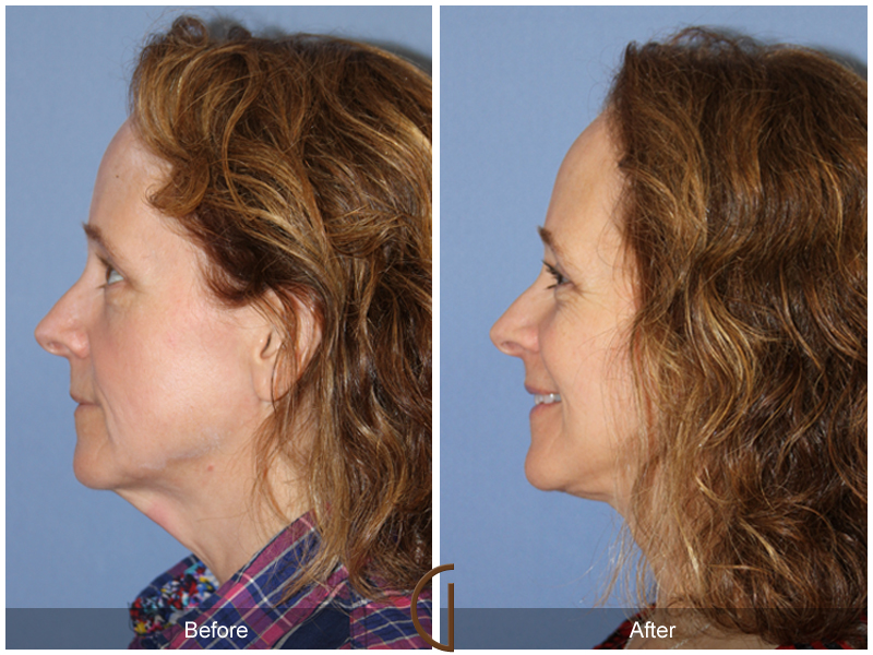 Female Facelift  Before & After Image