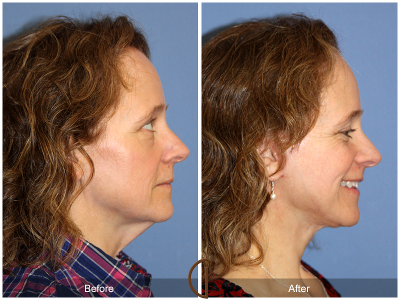 Female Facelift  Before & After Image