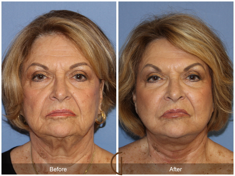 Female Facelift  Before & After Image