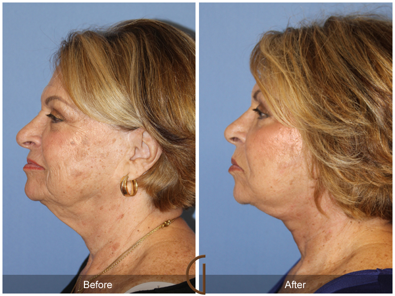 Female Facelift  Before & After Image