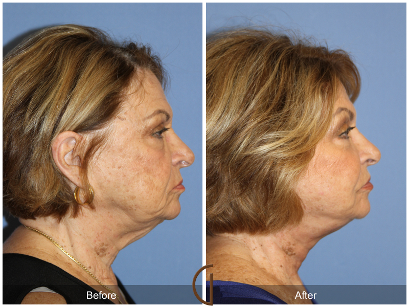 Female Facelift  Before & After Image