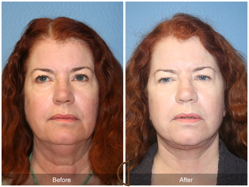 Female Facelift  Before & After Image