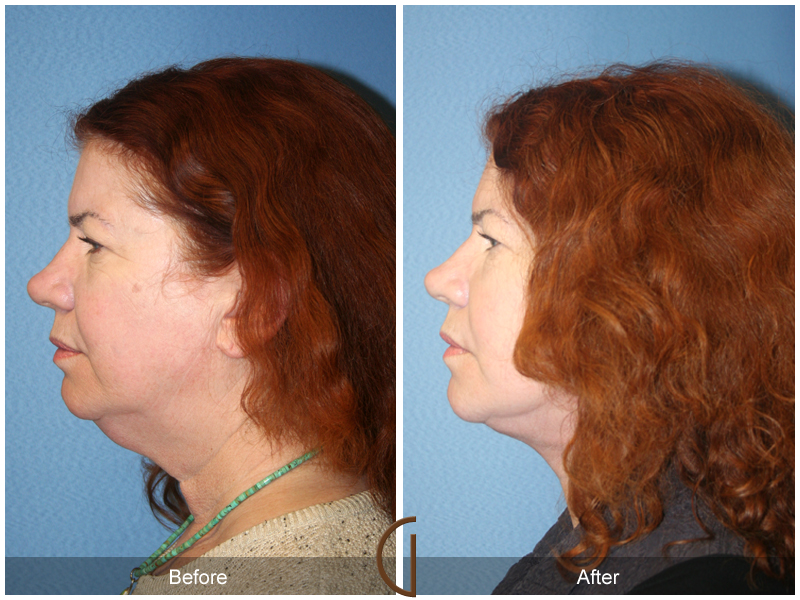 Female Facelift  Before & After Image