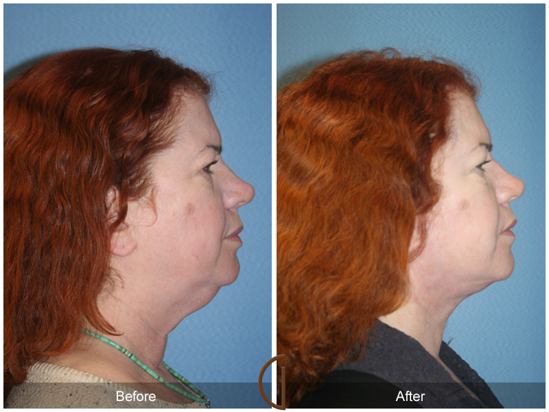 Female Facelift  Before & After Image