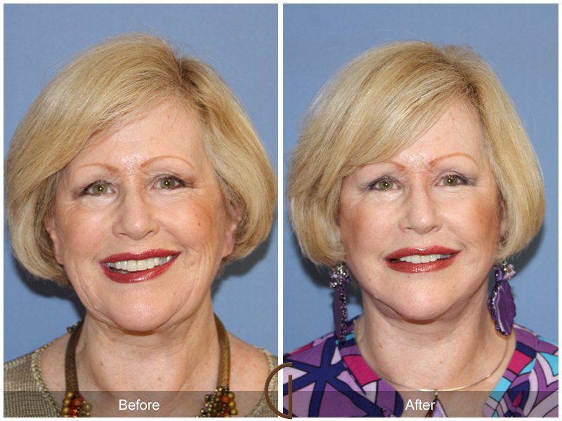 Female Facelift  Before & After Image