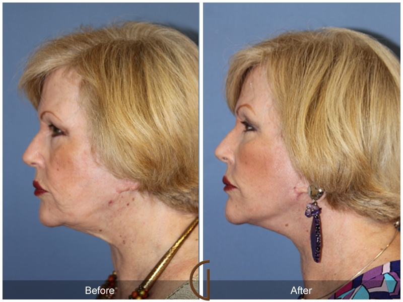 Female Facelift  Before & After Image