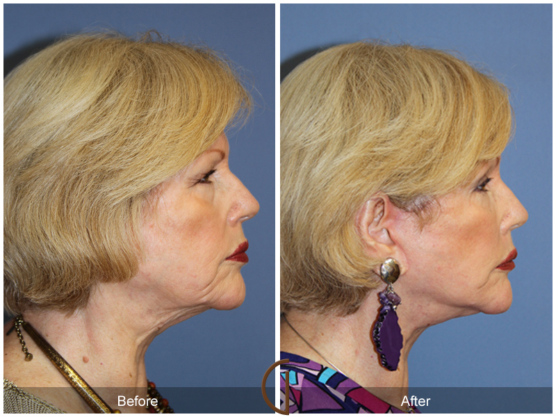 Female Facelift  Before & After Image