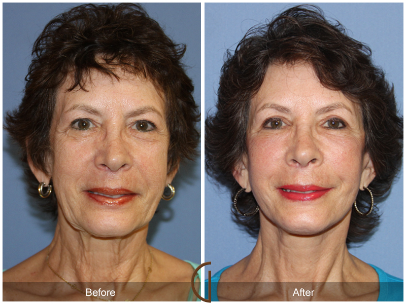 Female Facelift  Before & After Image