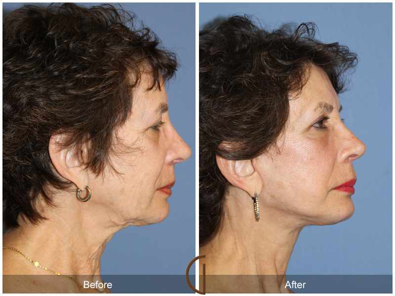 Female Facelift  Before & After Image