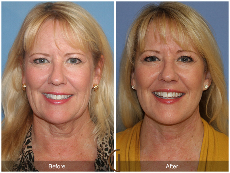 Female Facelift  Before & After Image