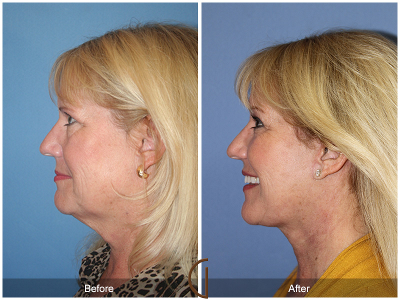 Female Facelift  Before & After Image