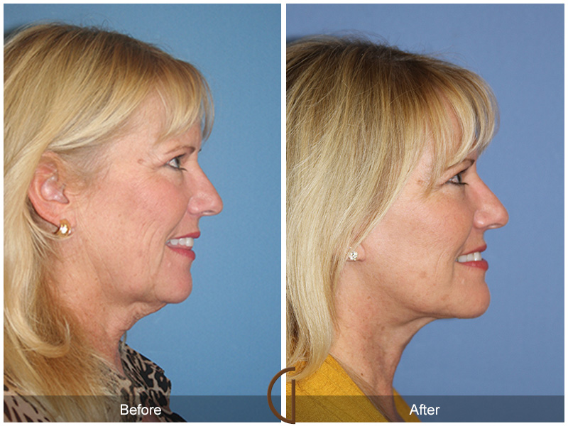 Female Facelift  Before & After Image