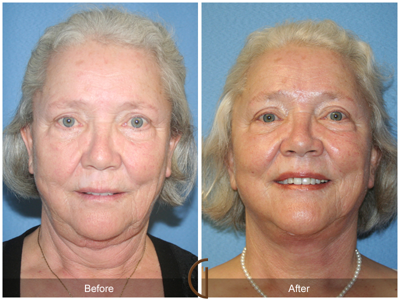 Female Facelift  Before & After Image