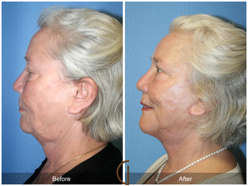 Female Facelift  Before & After Image