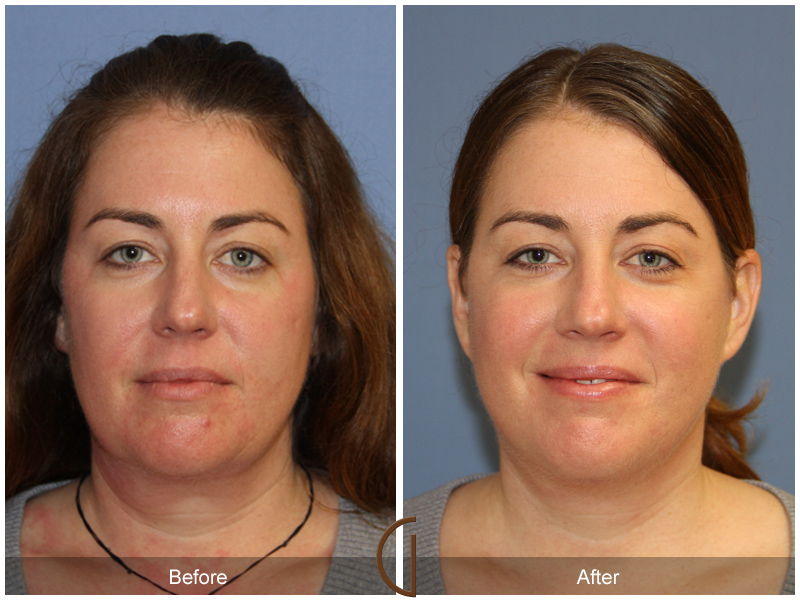 Female Facelift  Before & After Image