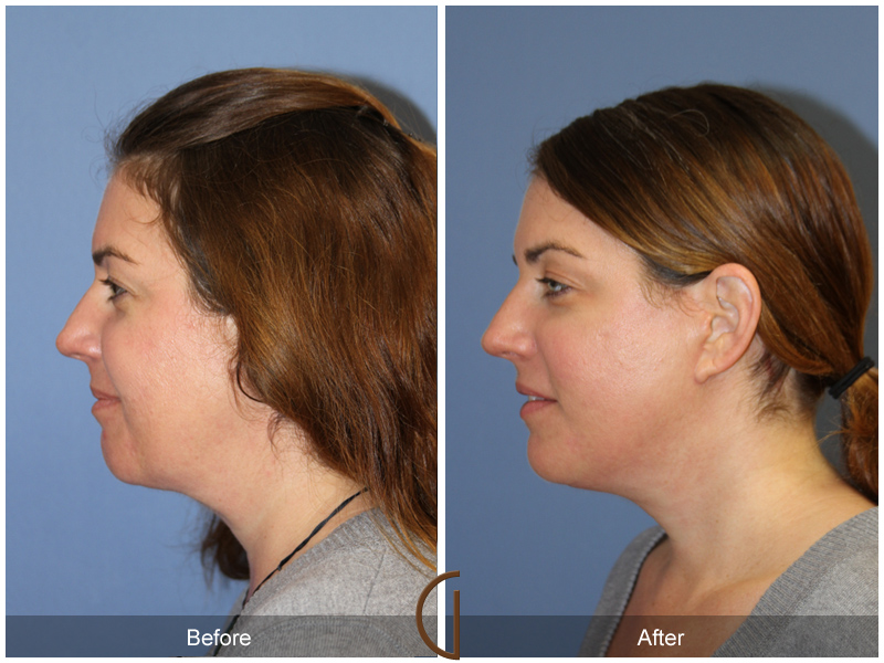 Female Facelift  Before & After Image