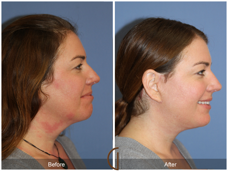 Female Facelift  Before & After Image