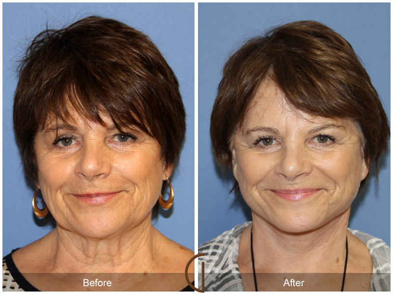 Female Facelift  Before & After Image