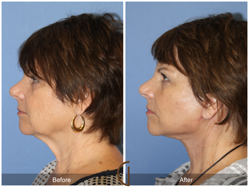 Female Facelift  Before & After Image