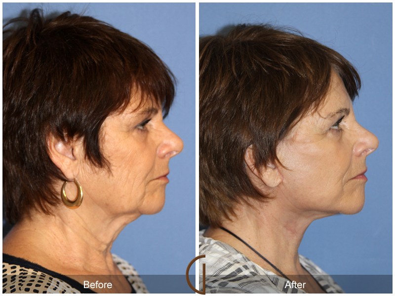 Female Facelift  Before & After Image