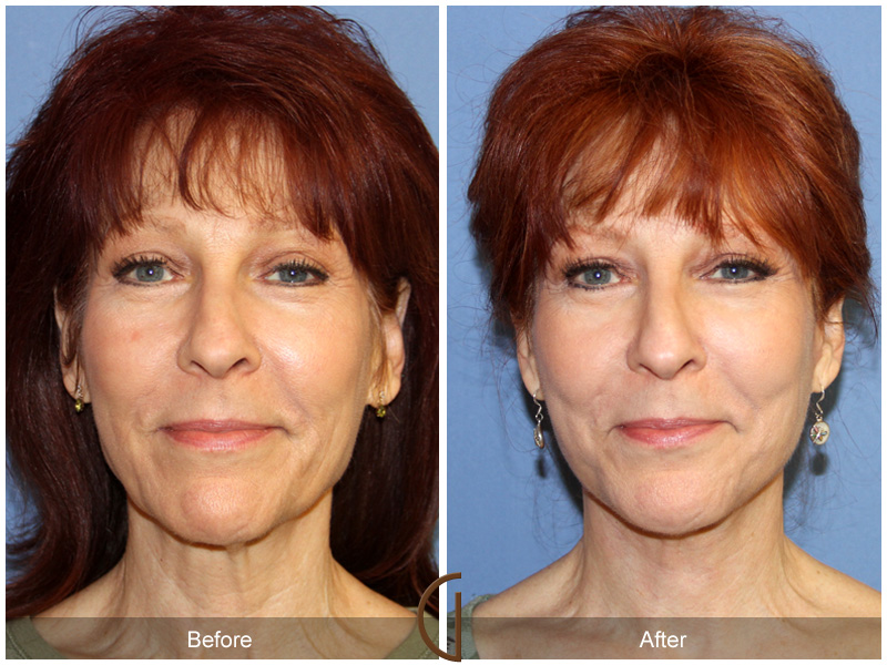 Female Facelift  Before & After Image