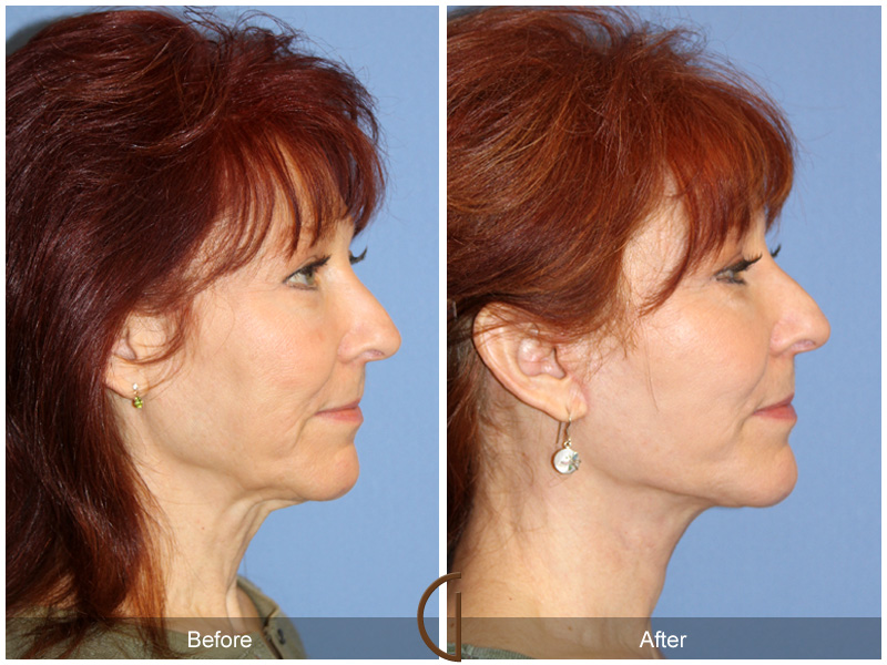 Female Facelift  Before & After Image